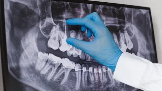 X-ray imaging showing jawbone structure evaluated for bone grafting