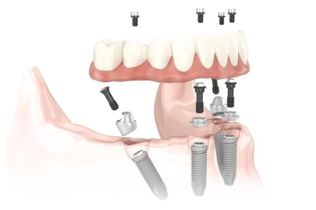 Full-arch All-on-4 implant prosthesis shown from the side