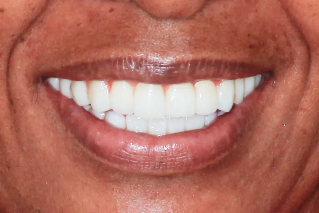 Case 1 after treatment at The Smile Bar