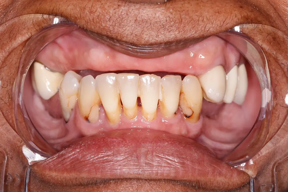 Case 1 before treatment at The Smile Bar