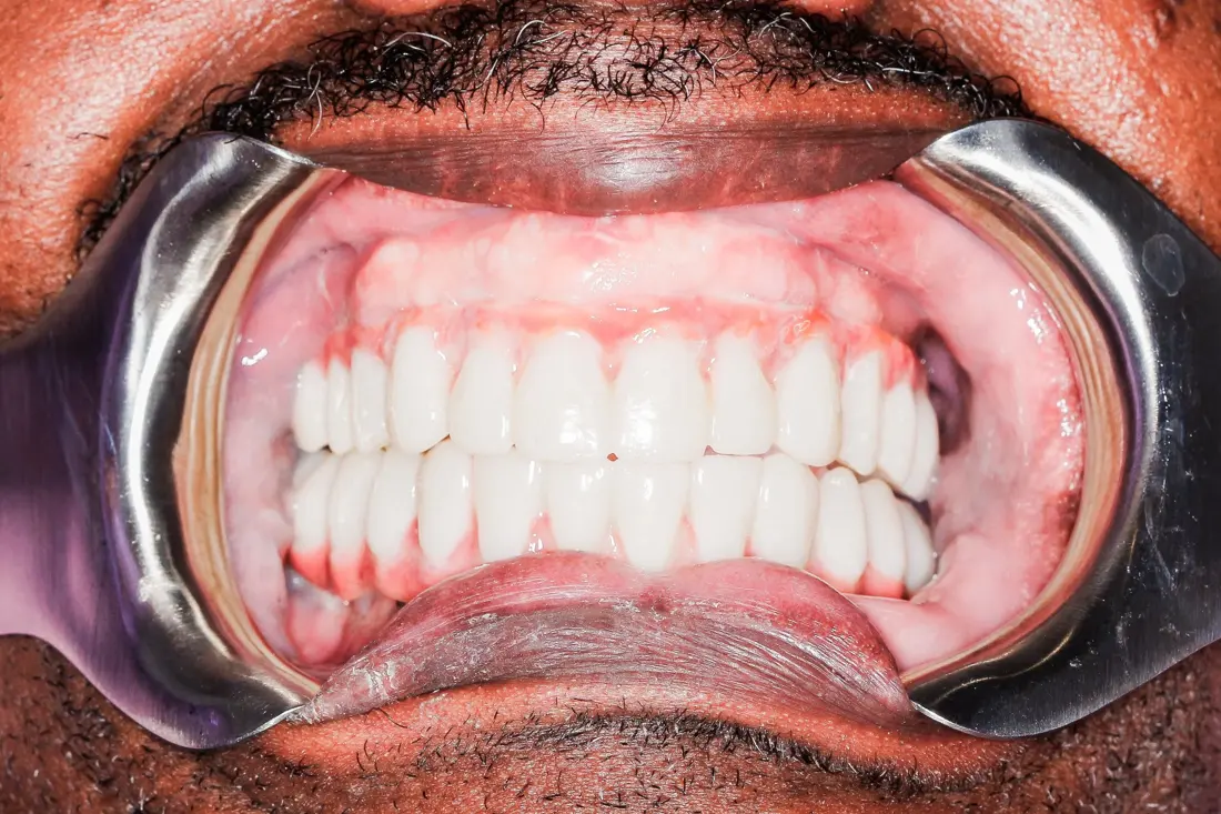 Case 2 after treatment at The Smile Bar
