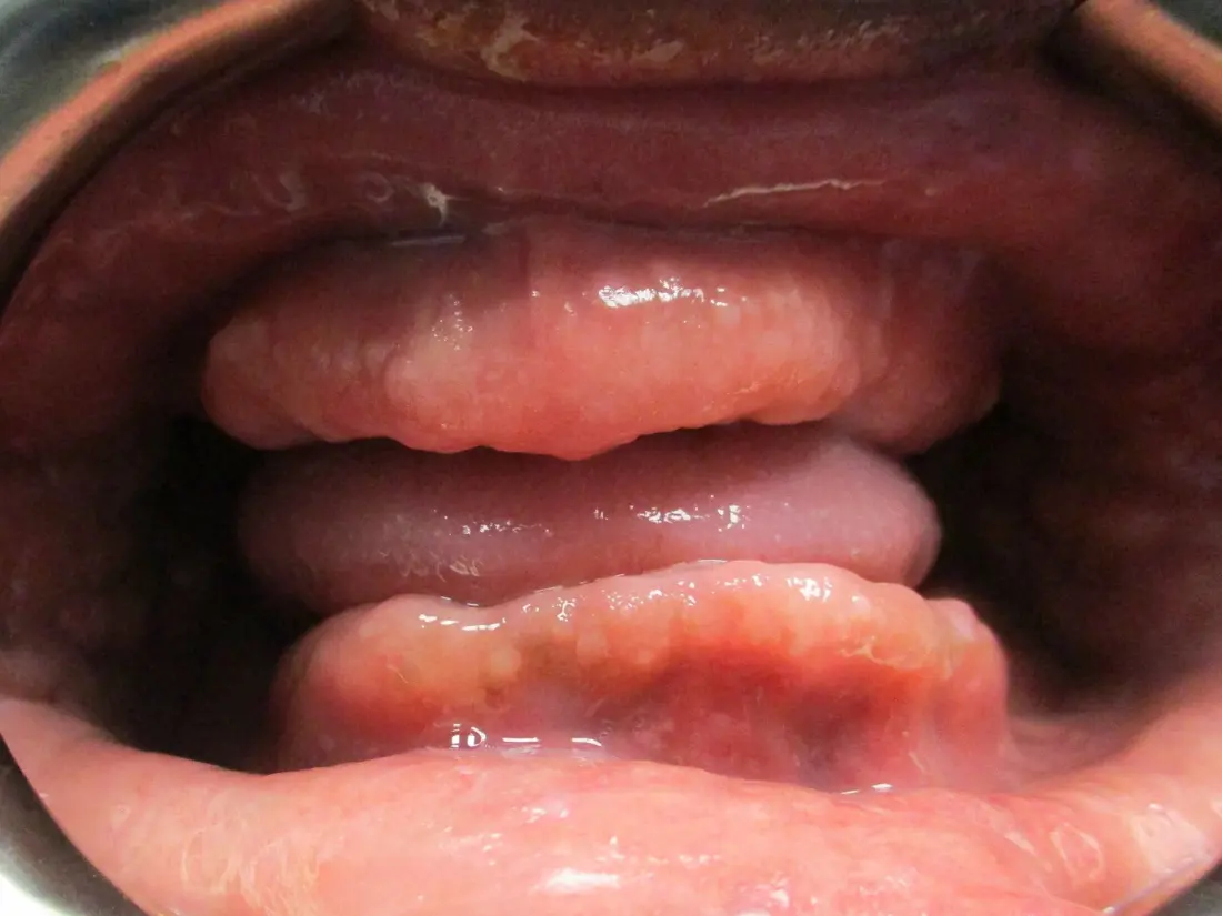 Case 2 before treatment at The Smile Bar