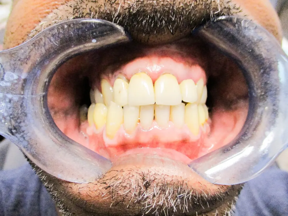 Case 3 after treatment at The Smile Bar