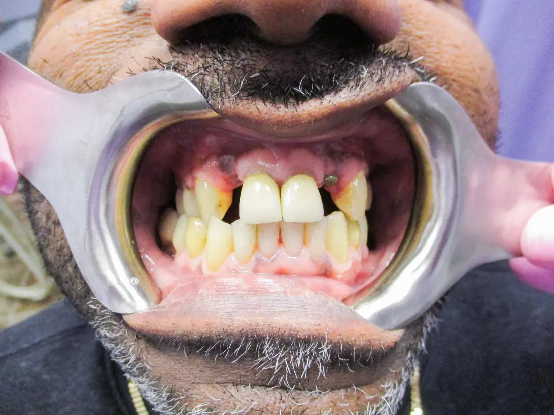 Case 3 before treatment at The Smile Bar