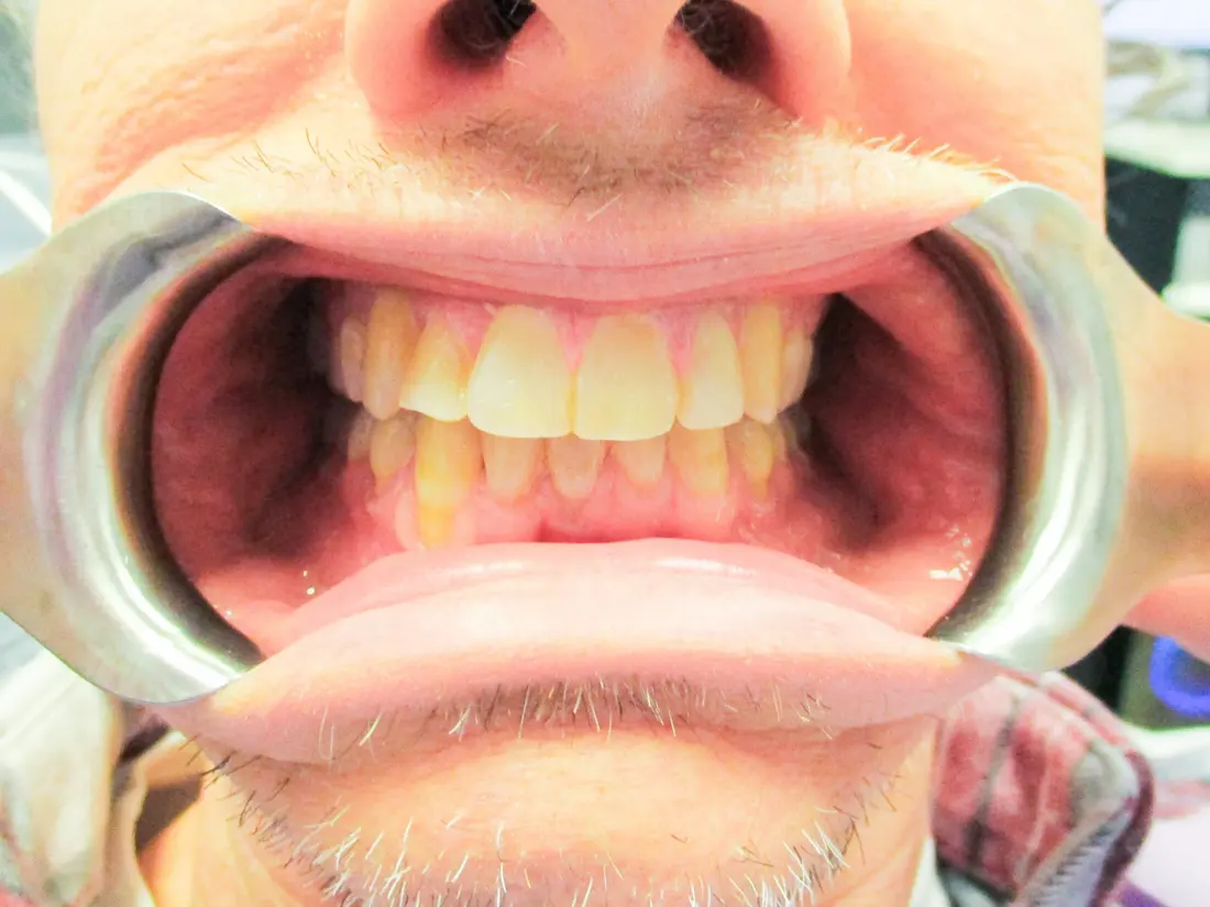Case 4 after treatment at The Smile Bar