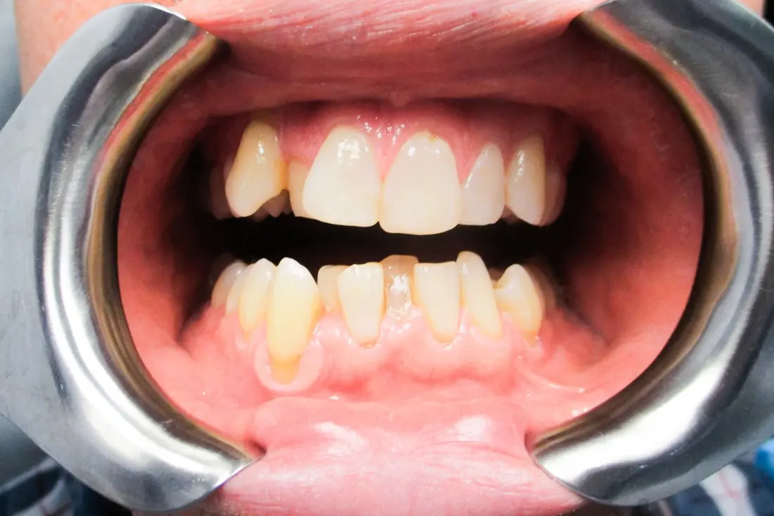 Case 4 before treatment at The Smile Bar