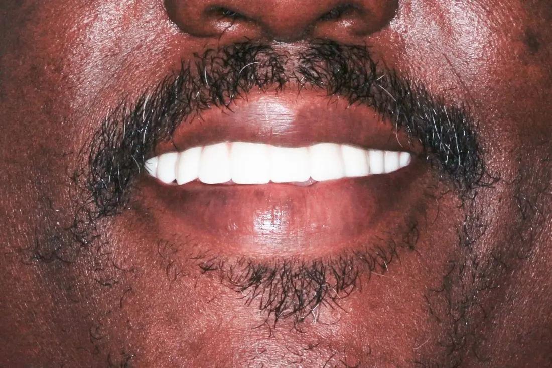 Case 5 after treatment at The Smile Bar