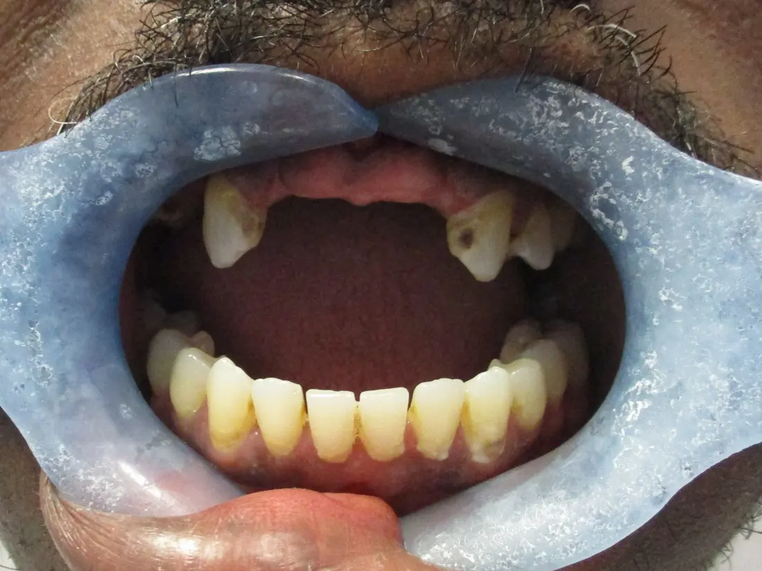 Case 5 before treatment at The Smile Bar