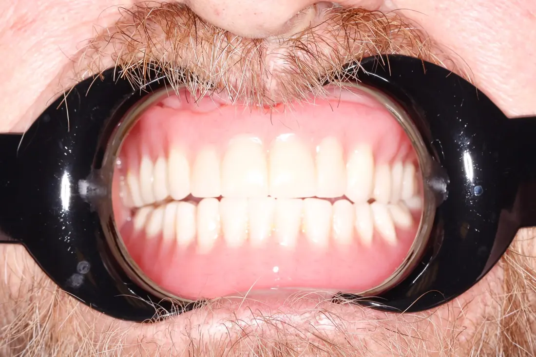 Case 6 after treatment at The Smile Bar