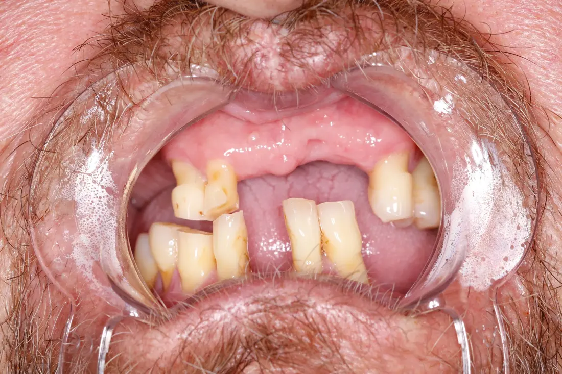 Case 6 before treatment at The Smile Bar