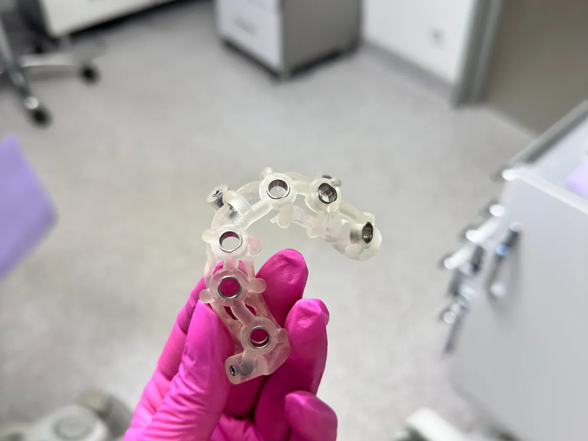 A 3D-printed surgical guide held in a gloved hand — printed in our lab so implants are placed exactly as planned