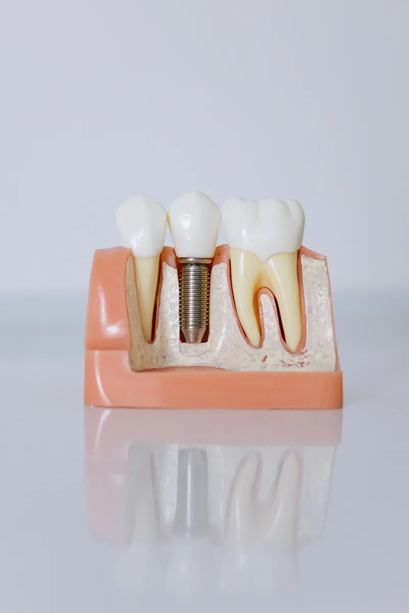 Cross-section model of a dental implant beside natural teeth — what your investment builds