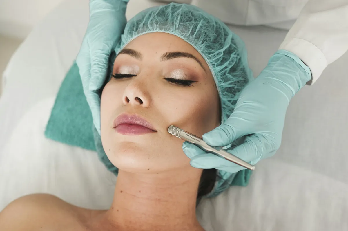 Microneedling treatment in progress on a patient's face
