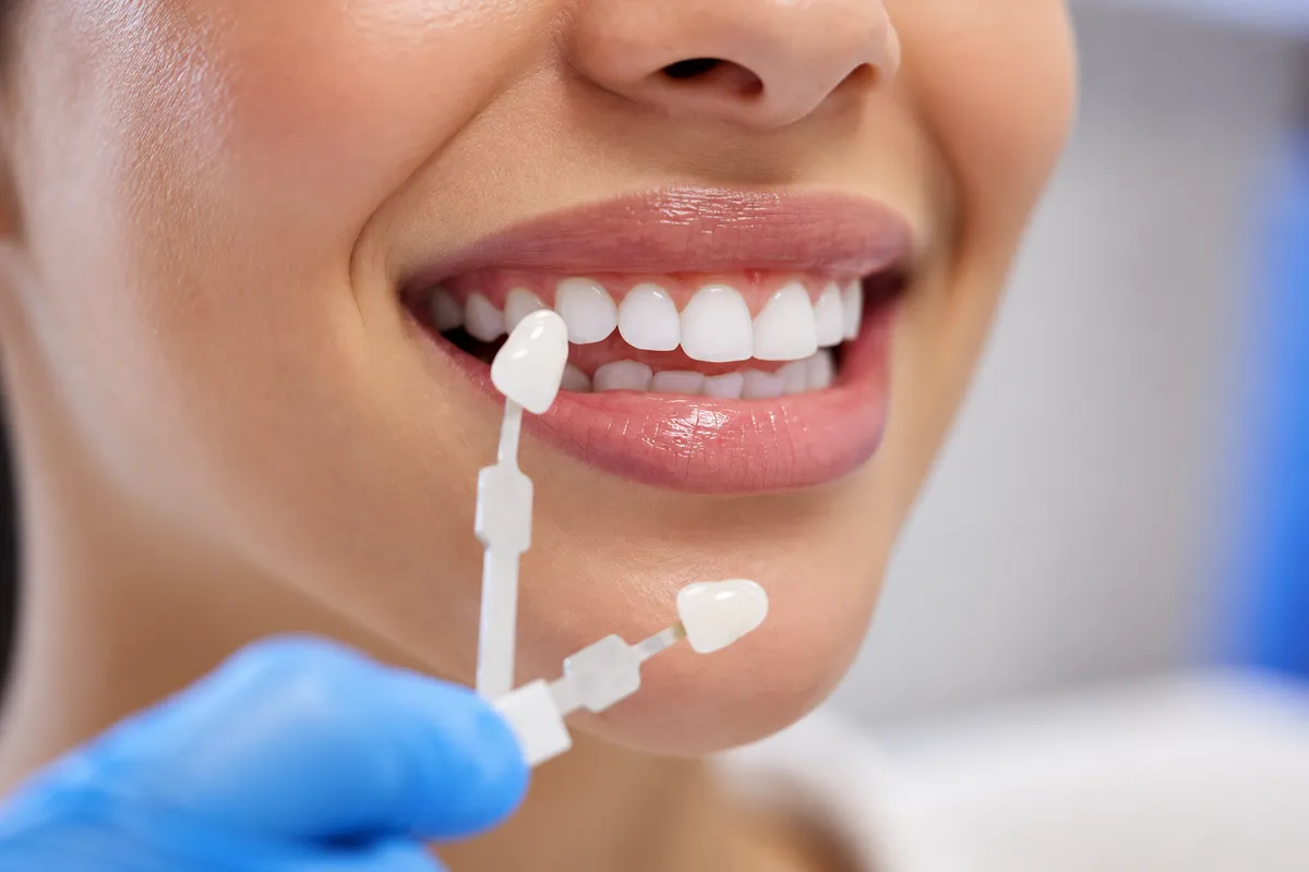 Veneer shade tabs held against a smiling patient's teeth